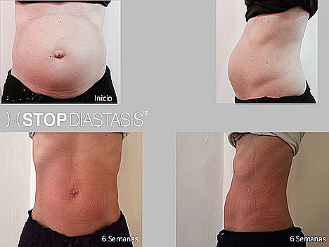 Un español idea un método revolucionario para recuperar el abdomen tras el parto