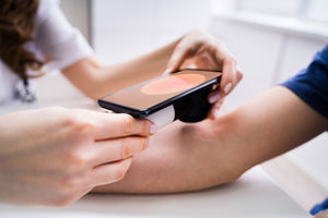 La autoexploración con el teléfono móvil facilita la detección precoz del melanoma