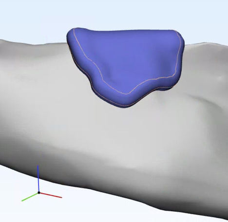 Diseño de plastia dental insertable en mandíbula, ostecar3d.